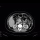 Fistula, retroperitoneal: CT - Computed tomography